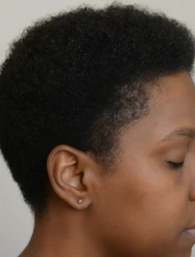 After treatment result